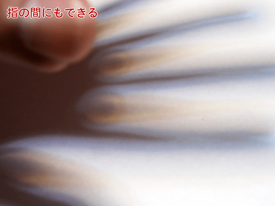 指の間にもできる